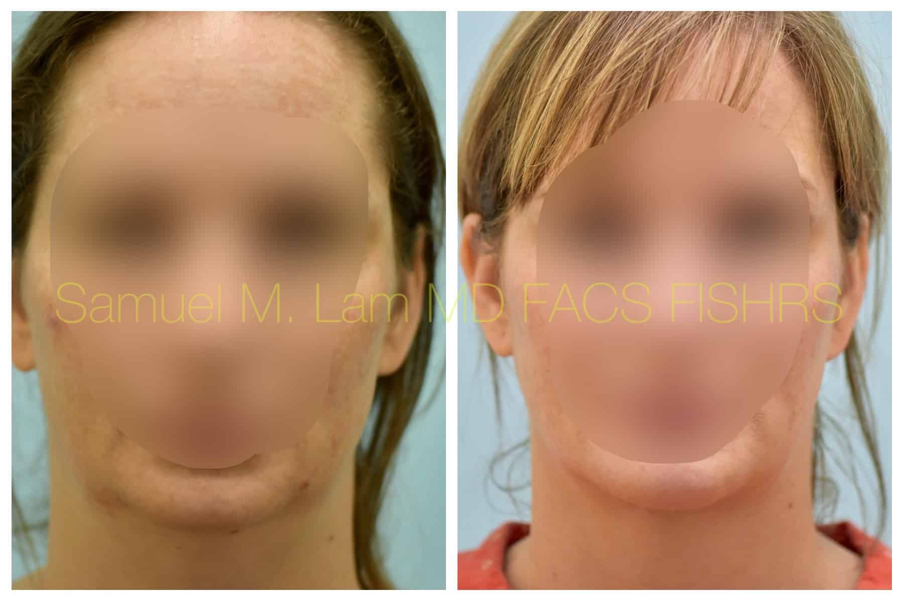 Facelift before and after photo