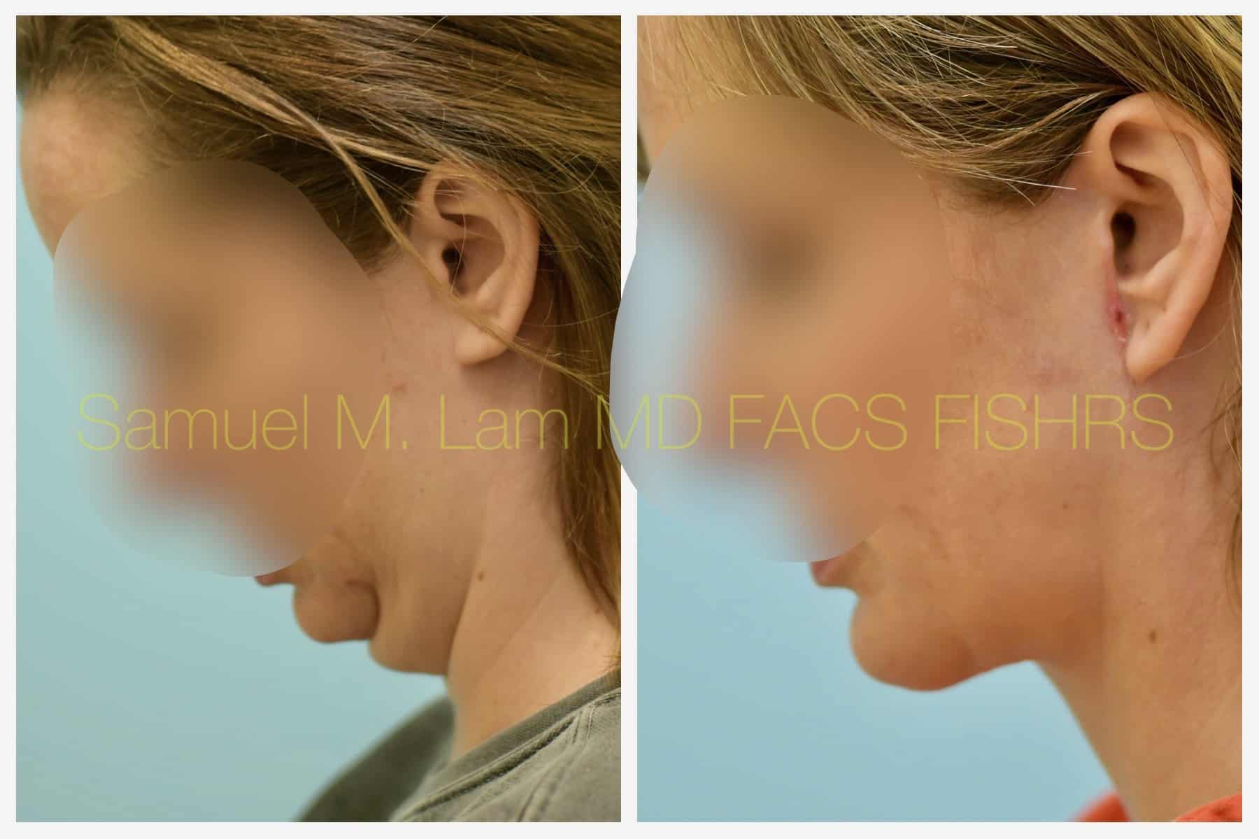 Facelift before and after photo