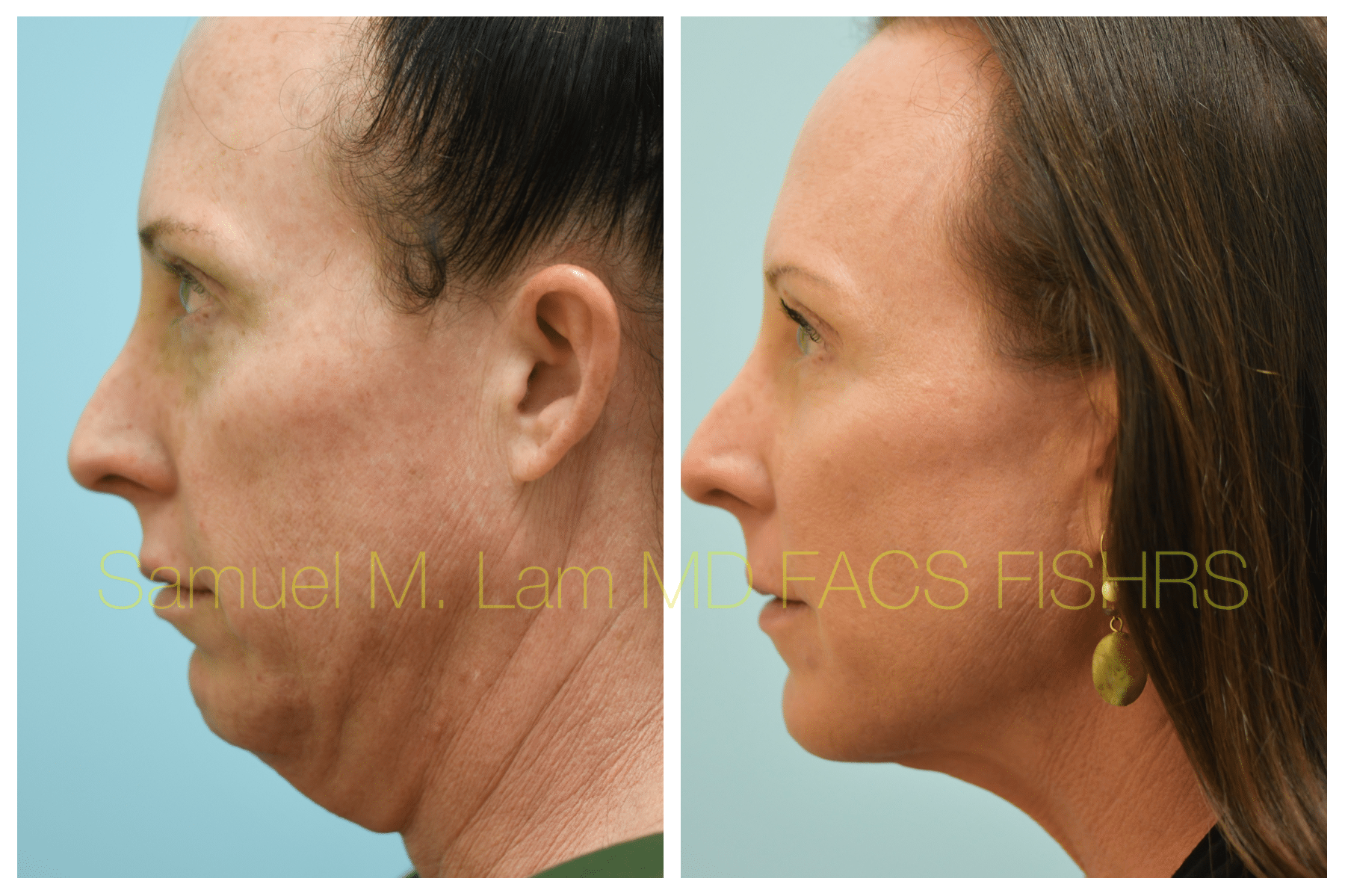 Facelift before and after photo
