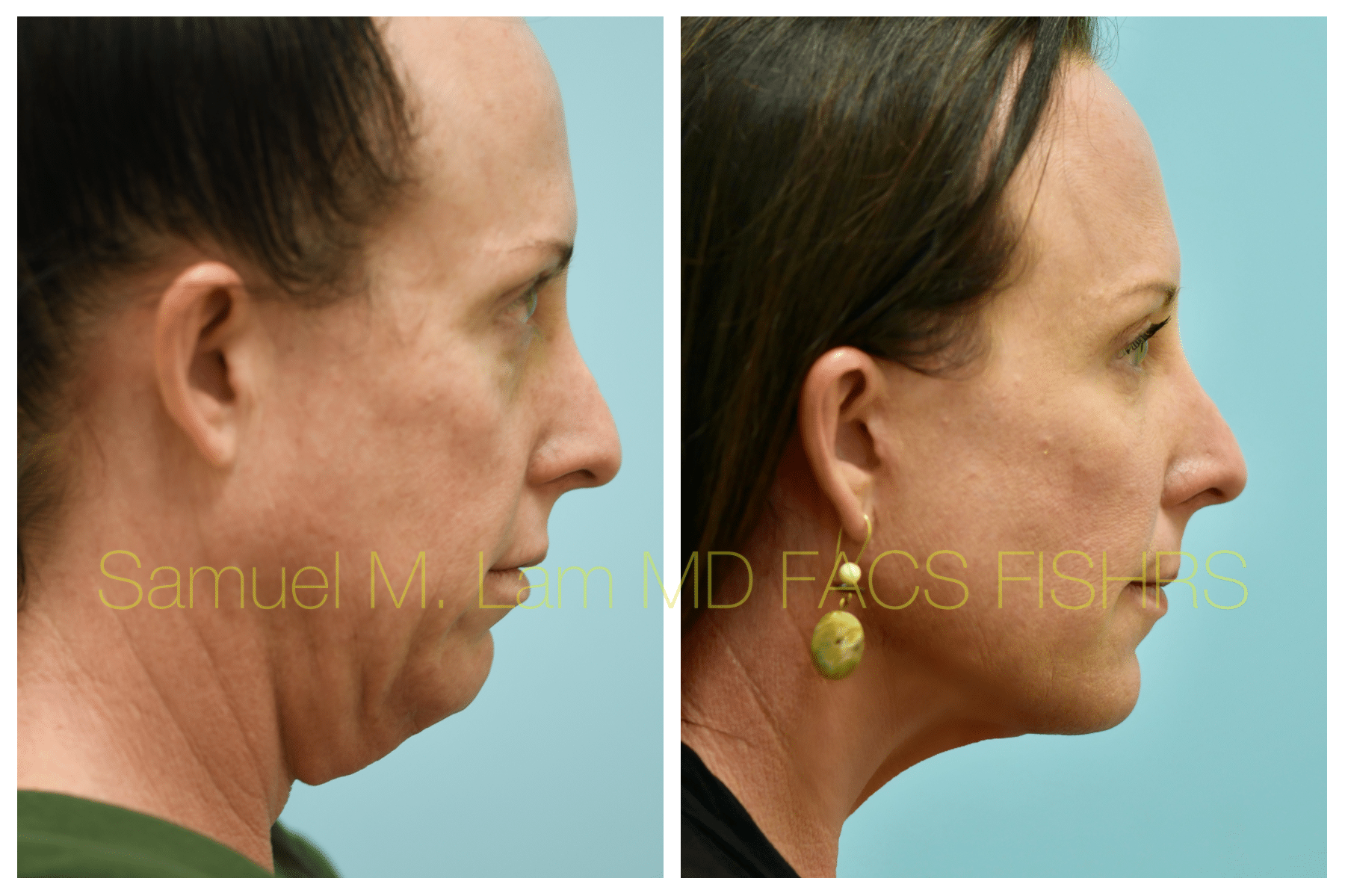 Facelift before and after photo