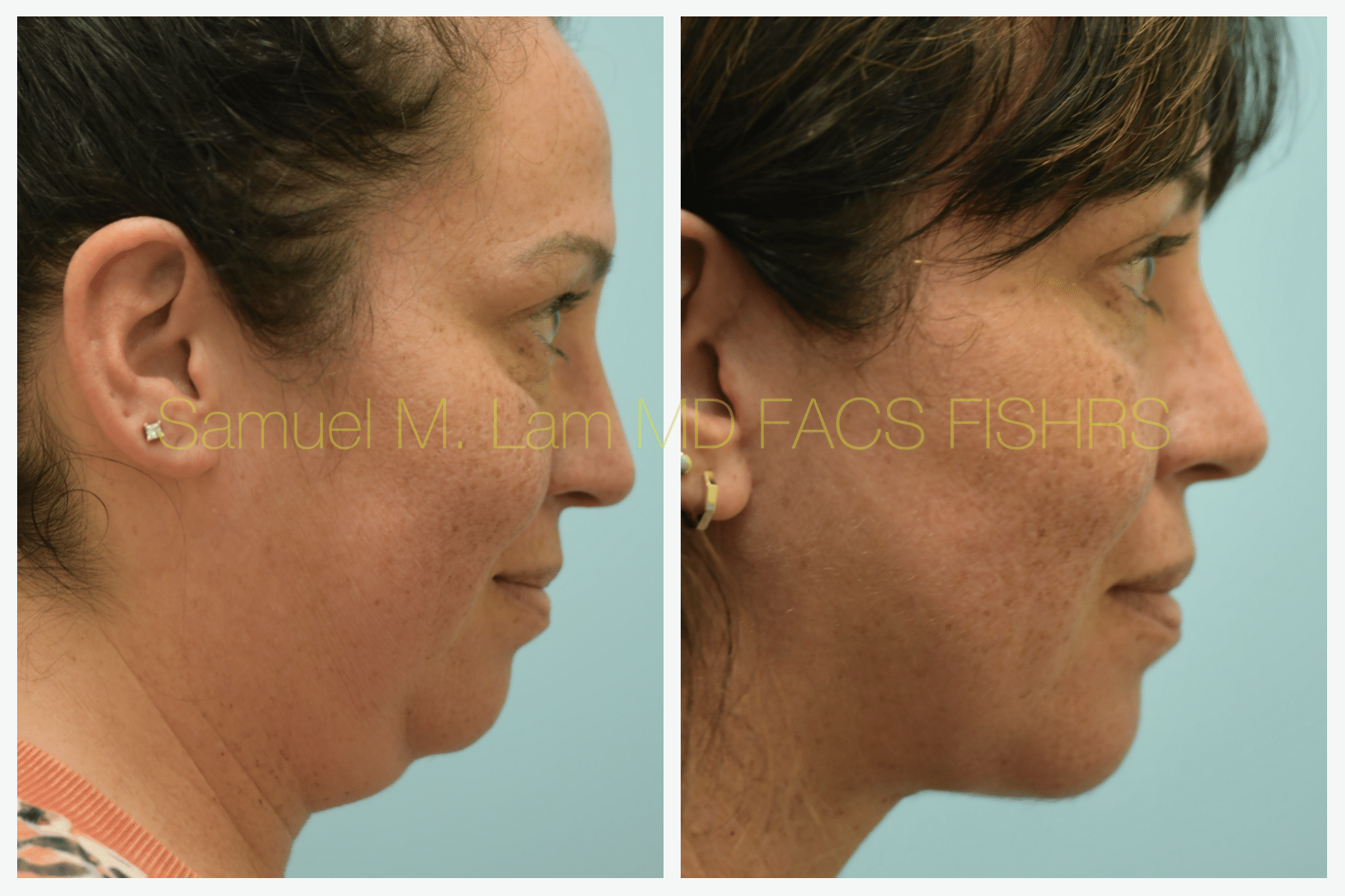 Facelift before and after photo by Dr. Lam