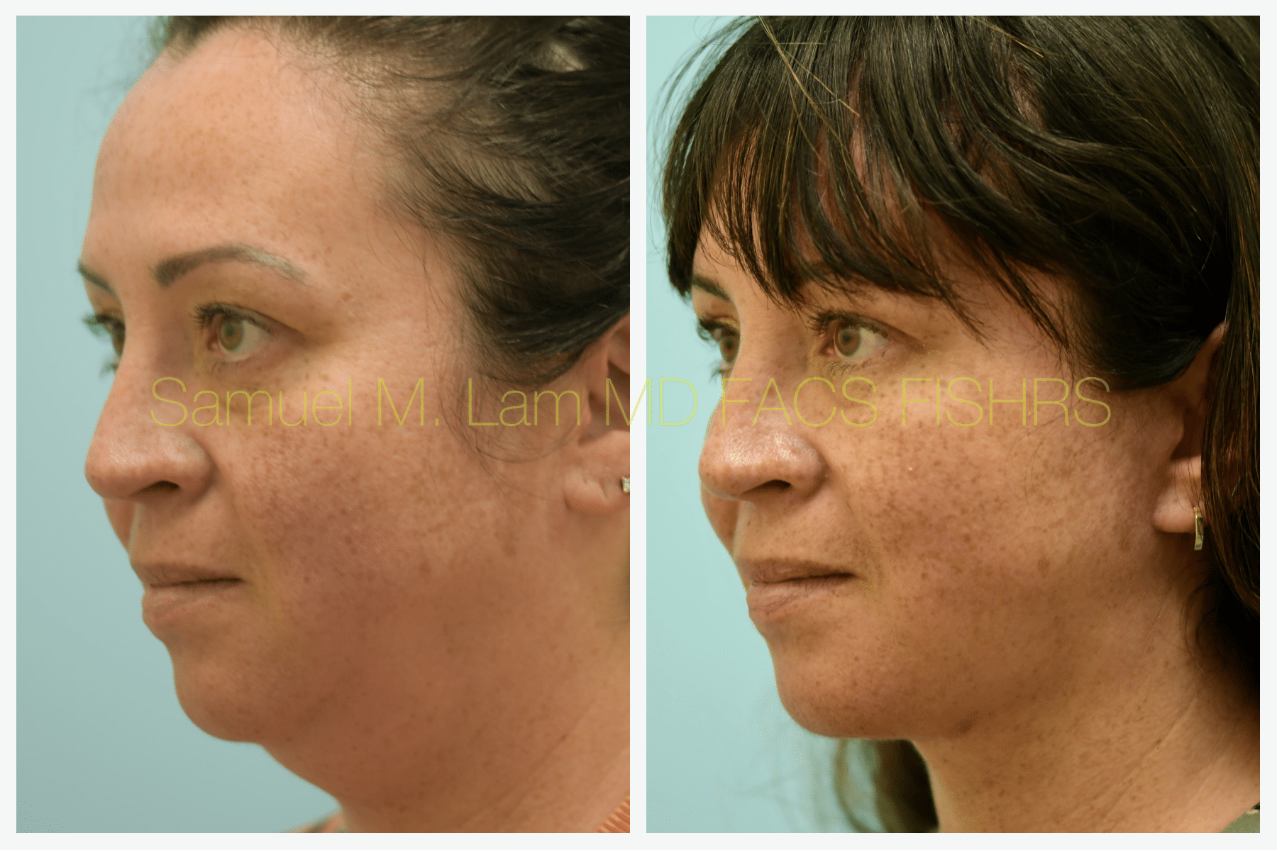 Facelift before and after photo