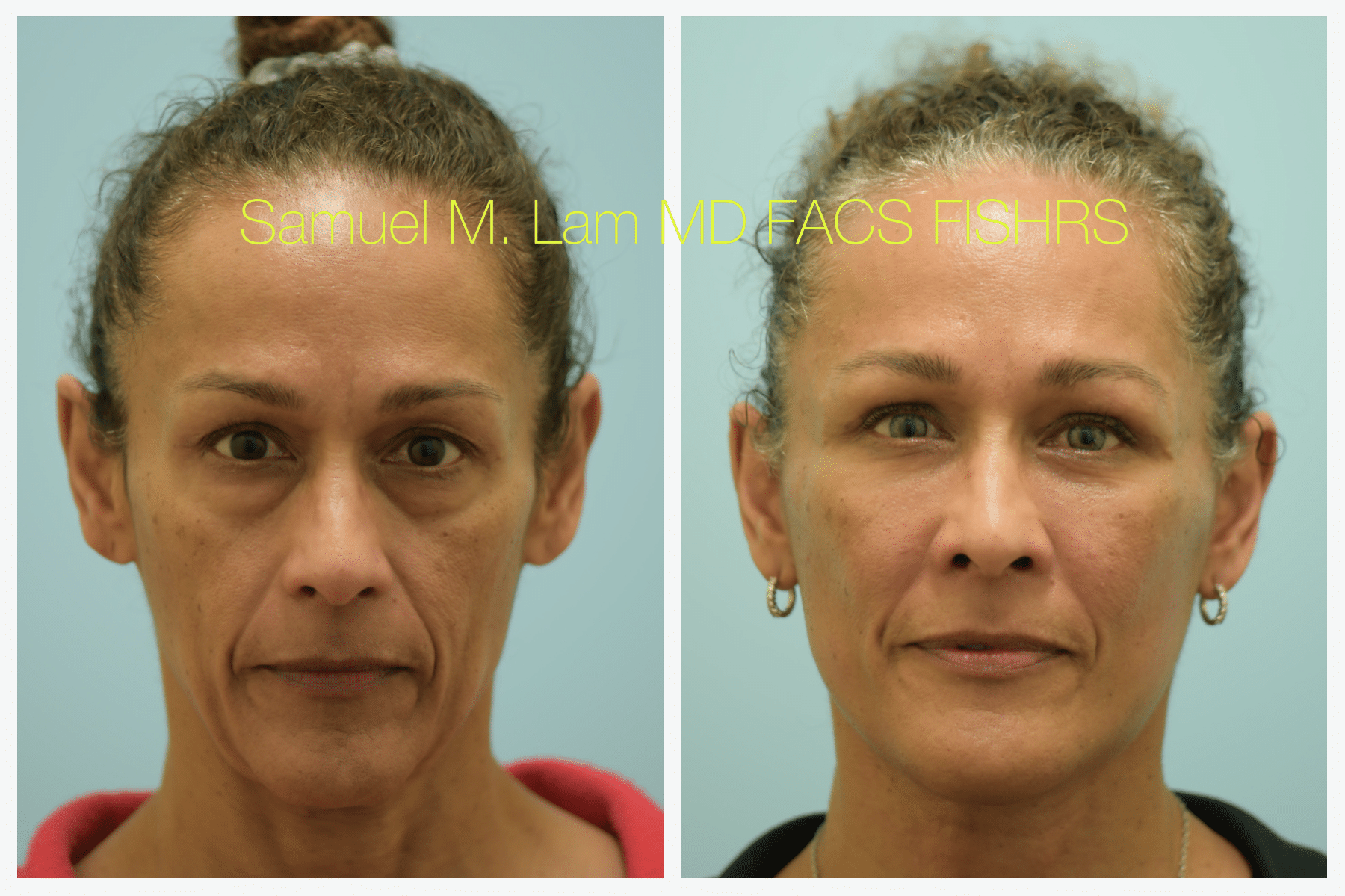 Facelift before and after photo