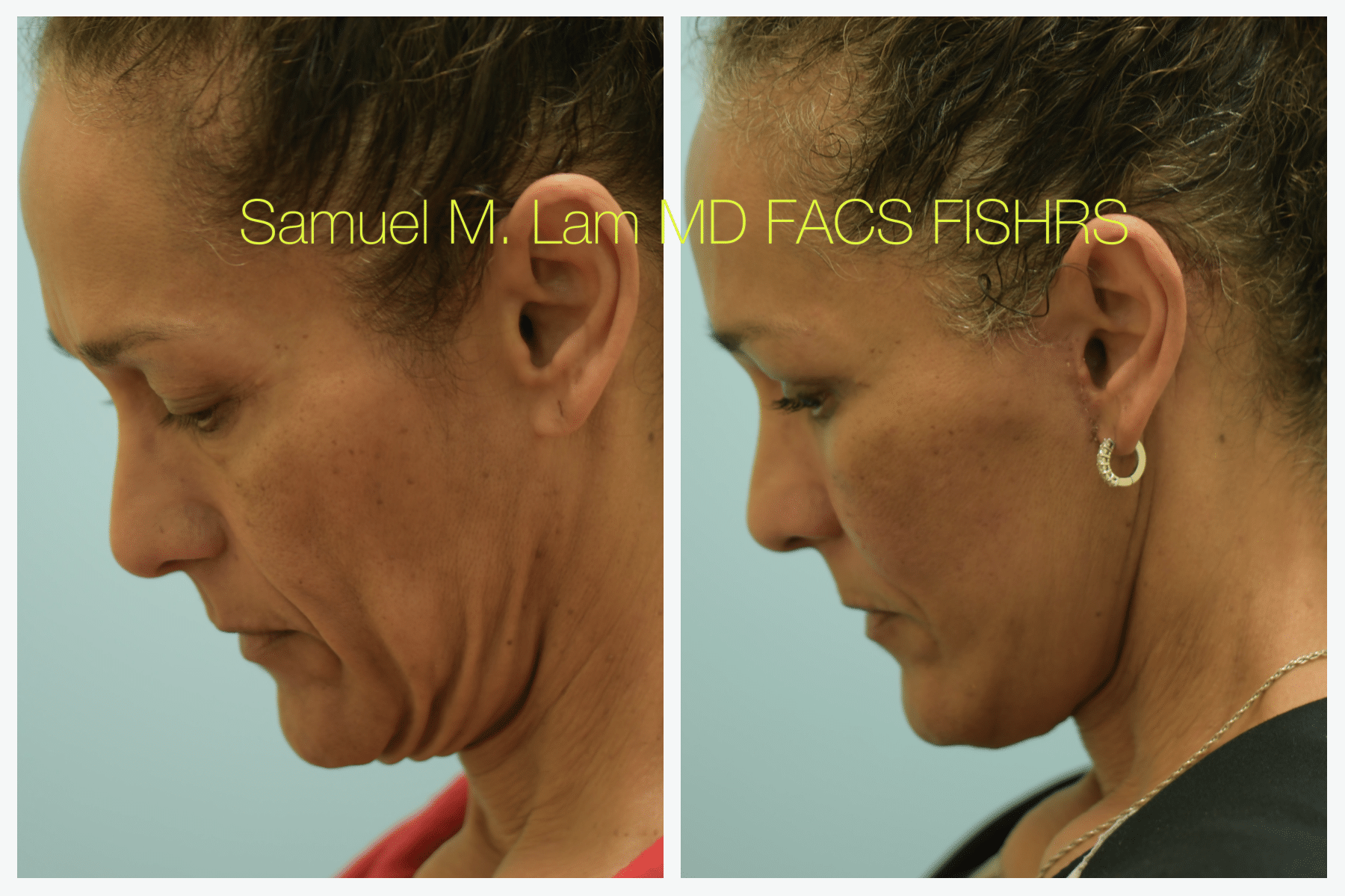 Facelift before and after photo