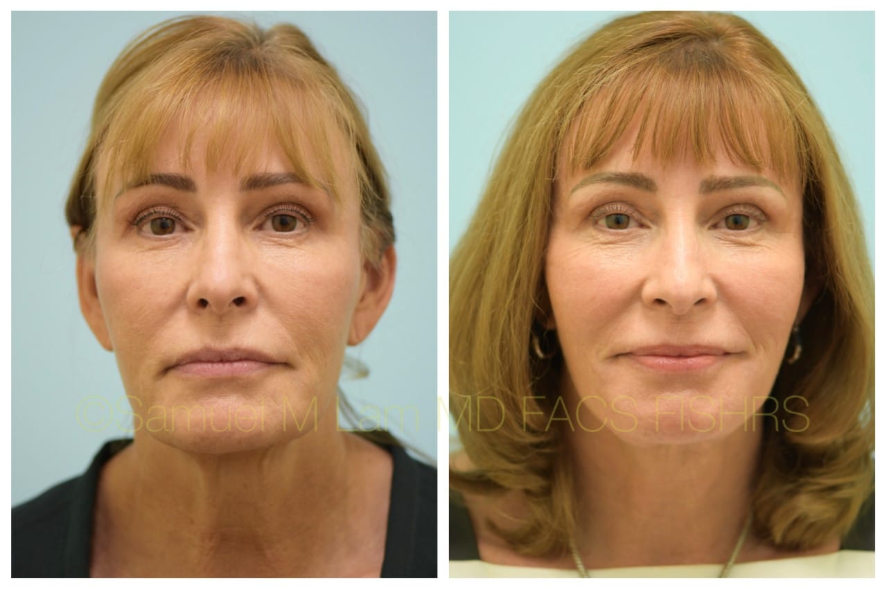 Facelift before and after photo