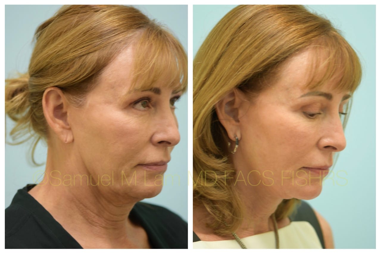 Facelift before and after photo
