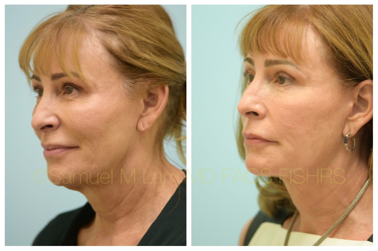 Facelift before and after photo