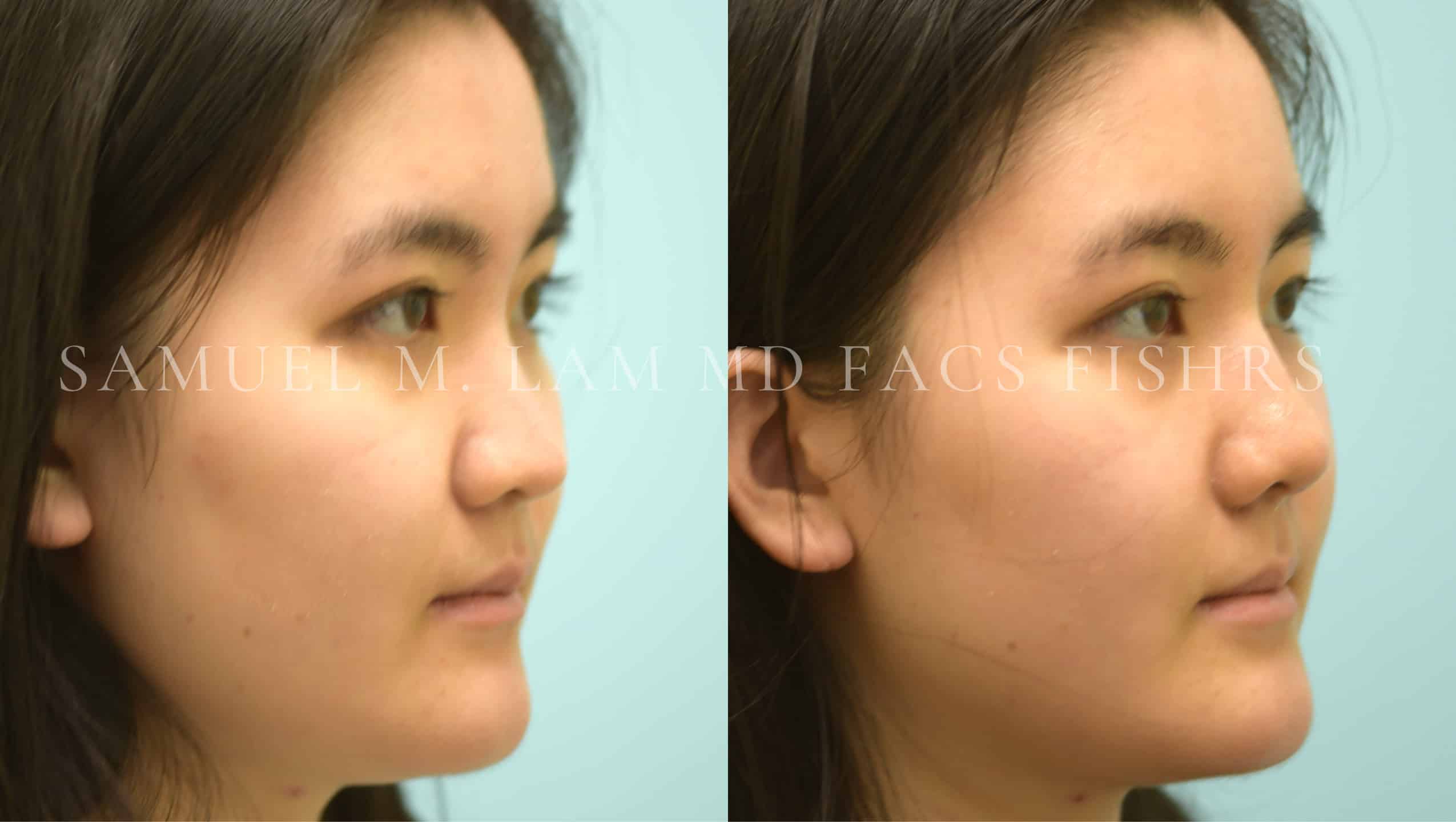 Rhinoplasty before and after photo