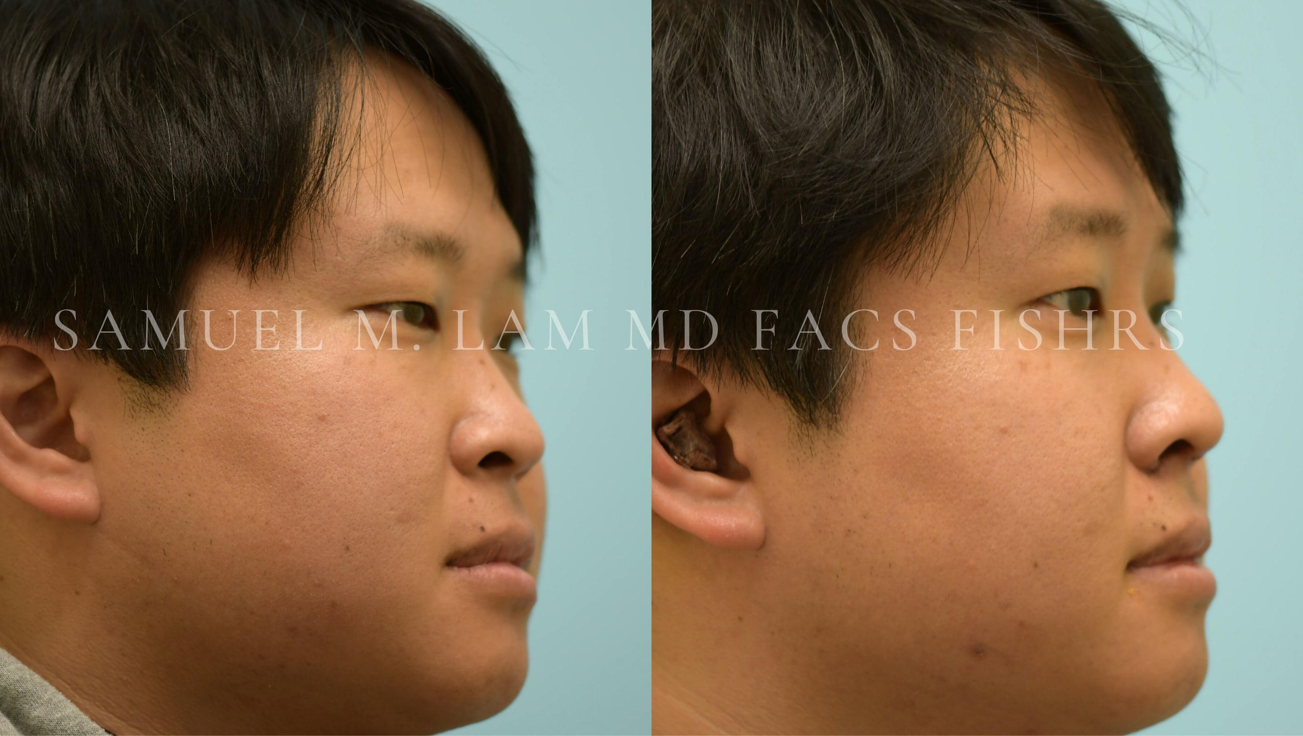 Rhinoplasty before and after photo