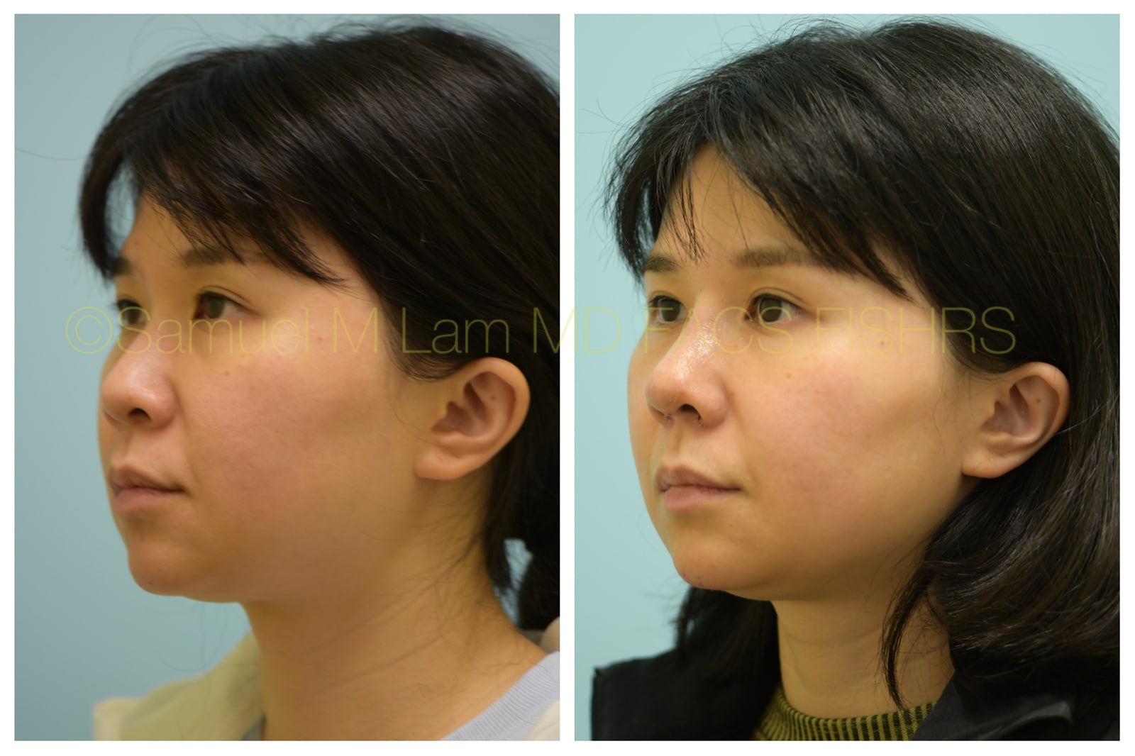 Rhinoplasty before and after photo