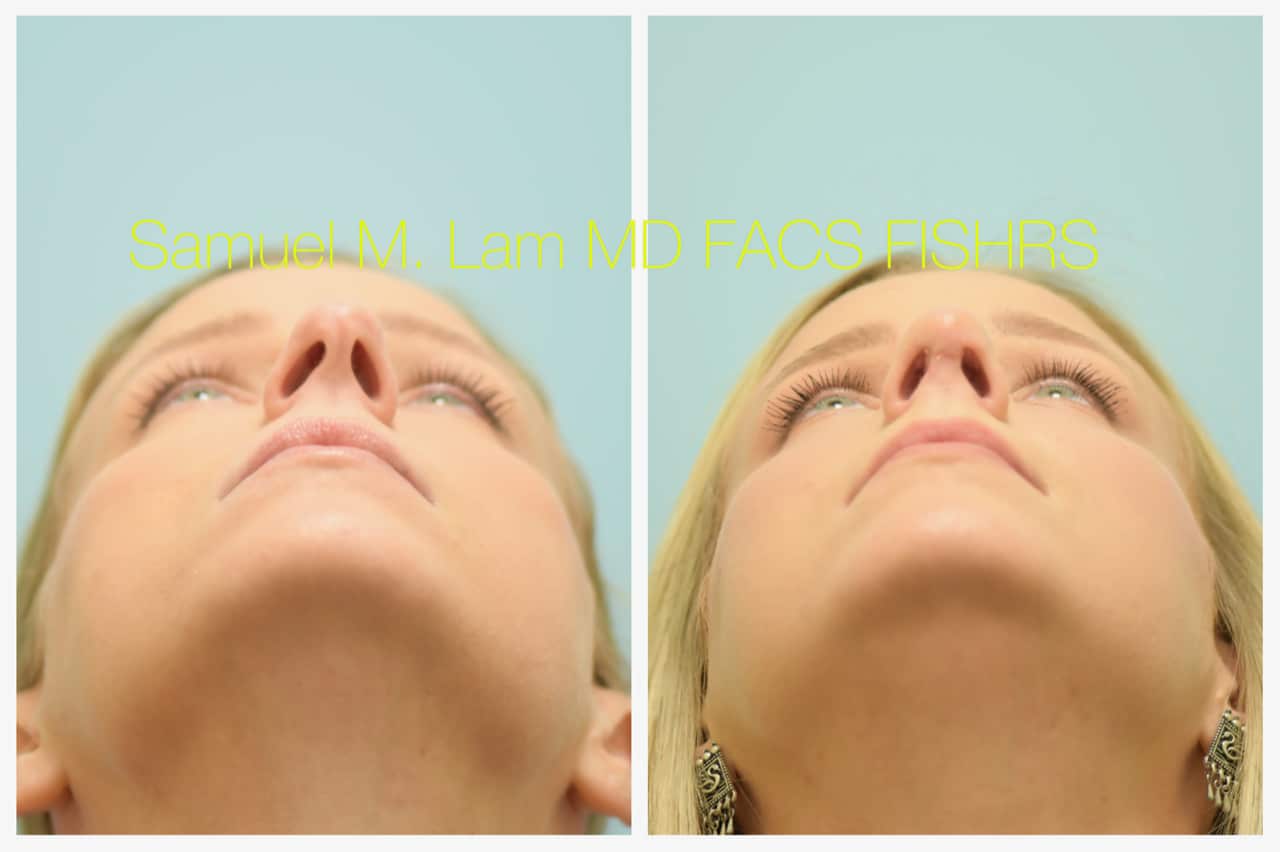 Rhinoplasty before and after photo