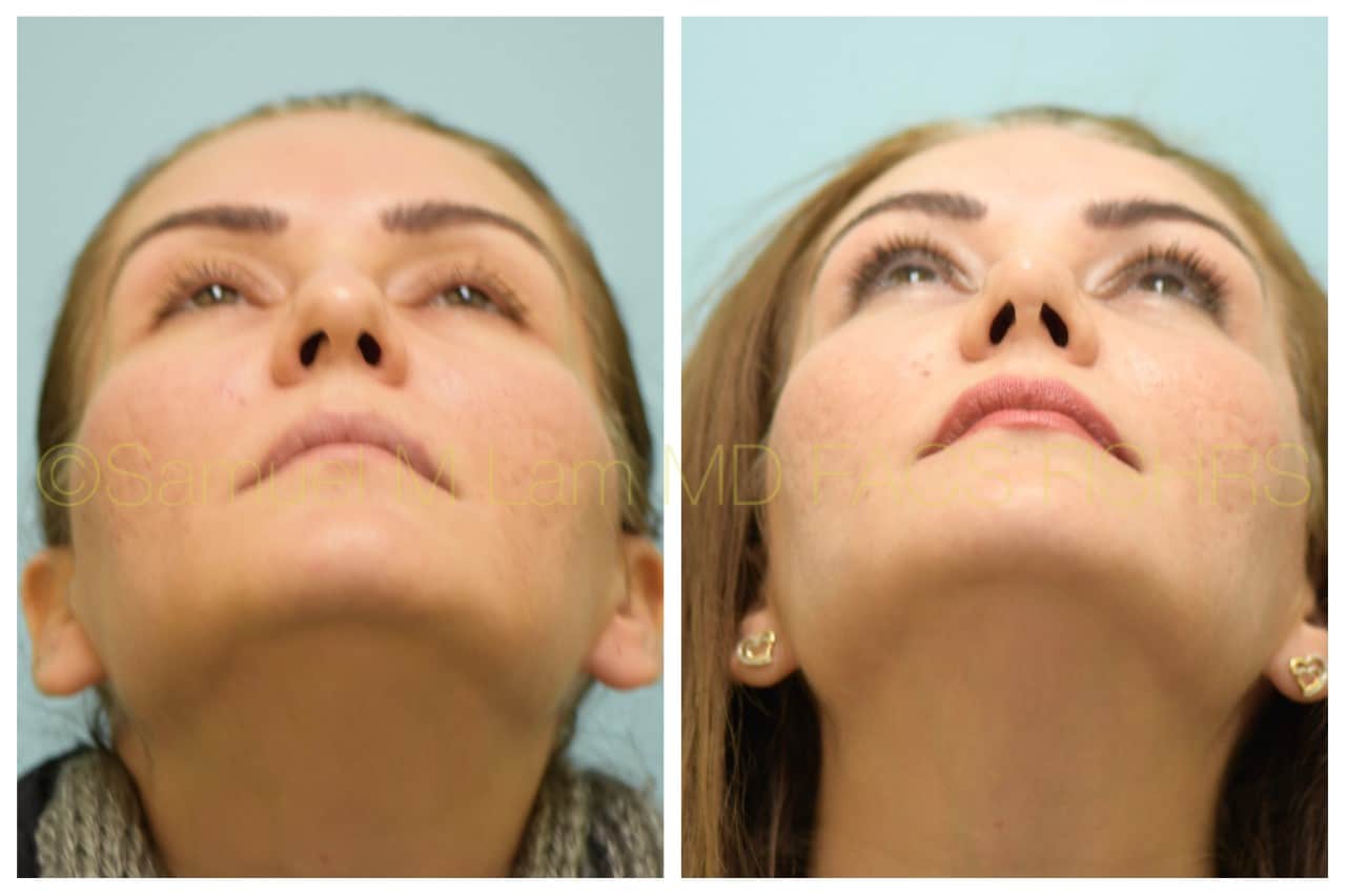 Rhinoplasty before and after photo