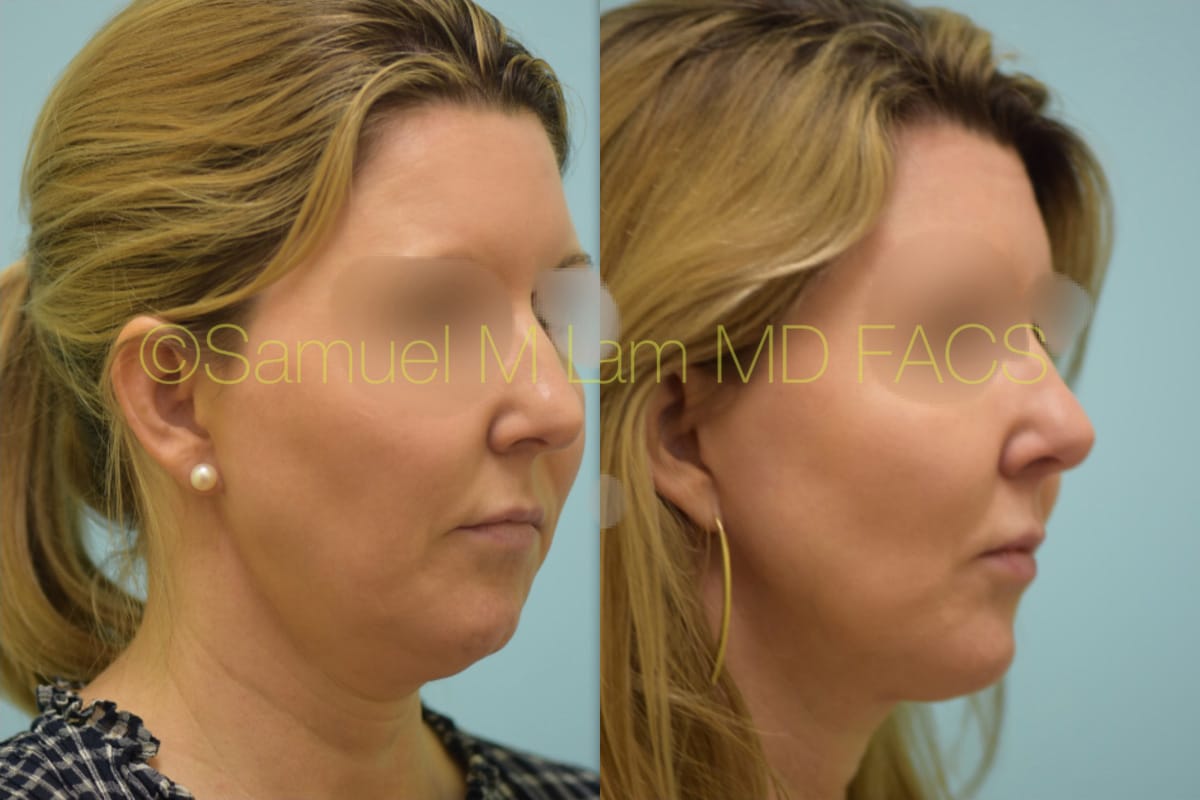 Rhinoplasty before and after photo