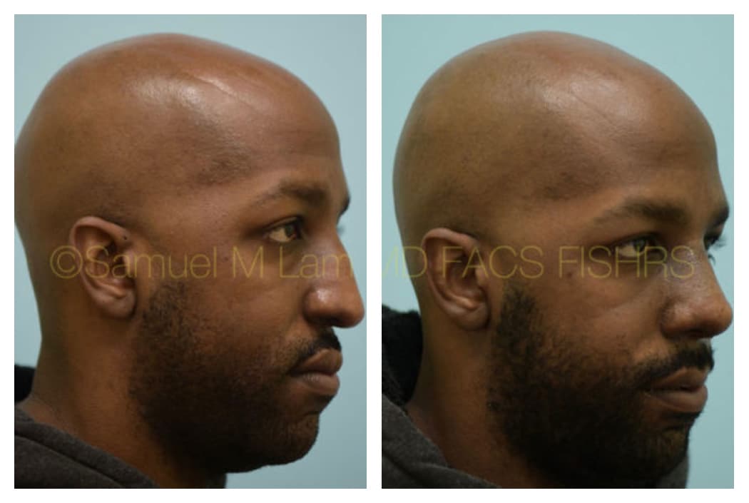 Rhinoplasty before and after photo