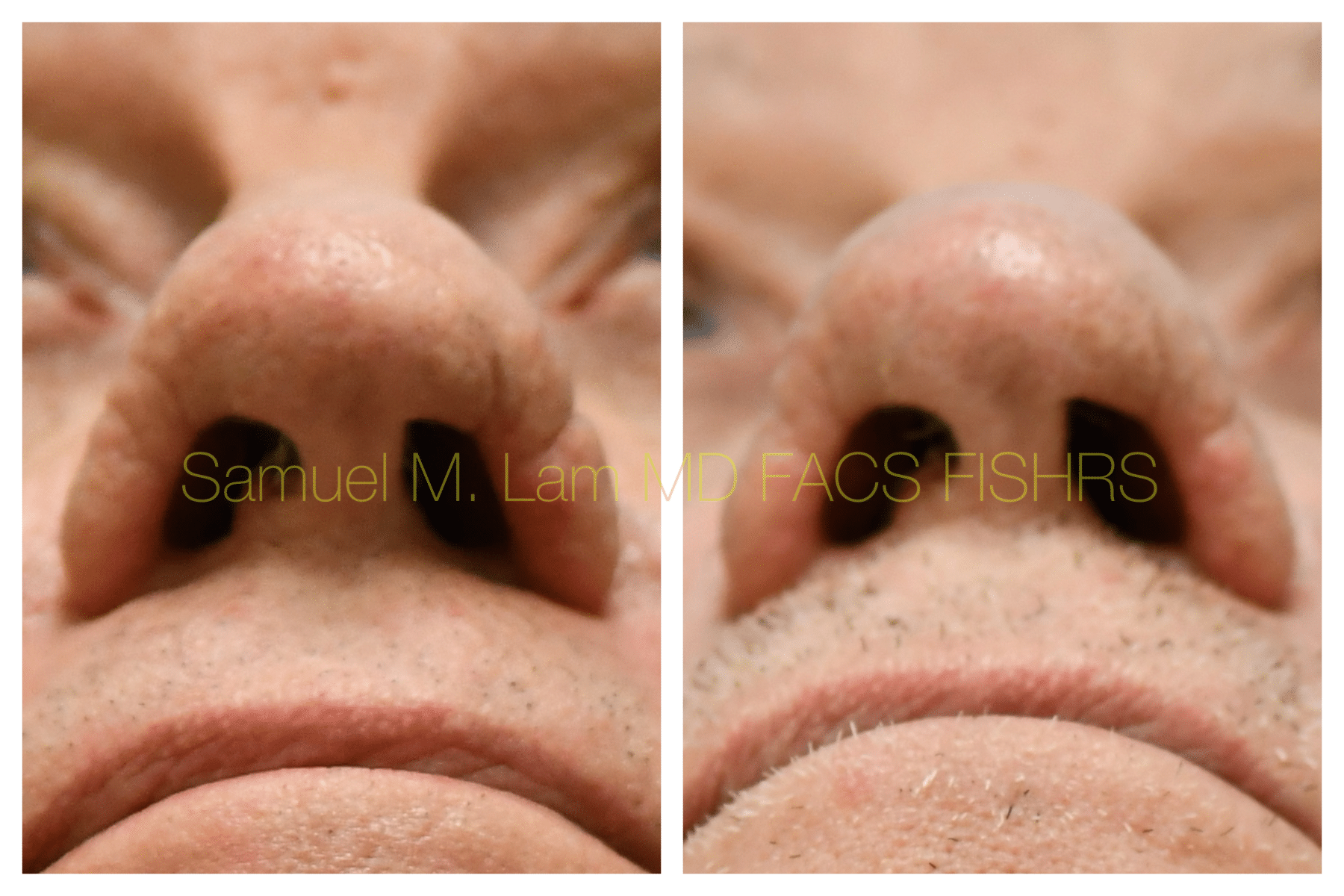 Rhinopyma rhinoplasty before and after photo